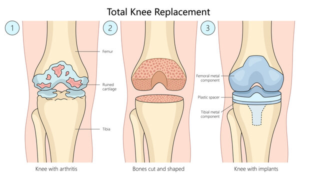 total knee replacement surgery, progression from arthritis-damaged knee to bone shaping and implant placement diagram hand drawn schematic vector illustration. Medical science educational illustration