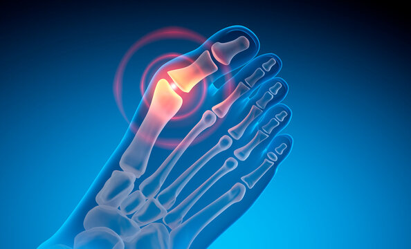 Hallux Valgus - Valgus deformity of the big toe - 3D illustration