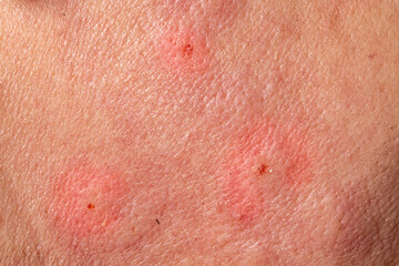 Fototapeta premium Close up of irritated skin showing redness and inflammation