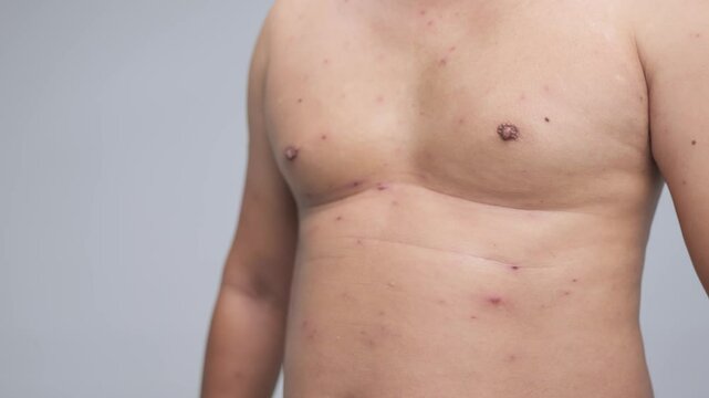 Male torso with visible chickenpox marks, rashes, and signs of skin allergies.