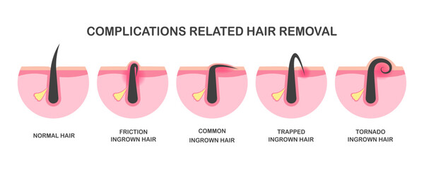 Ingrown hair, problems after hair removal, complications after epilation or depilation. Complications related hair removal.