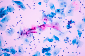 View in microscopic of Candidiasis, fungus infection (Yeast and Pseudohyphae form) in pap smear slide cytology and diagnostic by pathologist.Gynecology report and diagnosis.Sexually transmitted infect