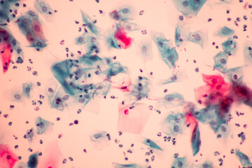 View in microscopic of Candidiasis, fungus infection (Yeast and Pseudohyphae form) in pap smear...