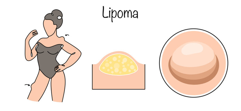 Lipoma