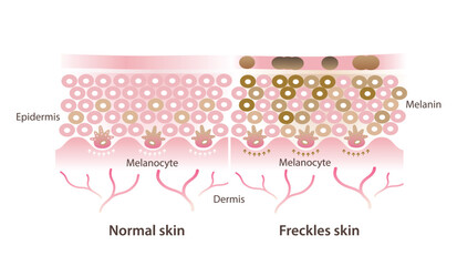 Comparison of normal and freckles skin vector illustration isolated on white background. Cross section of healthy skin layer and  melanocytes make more melanin that develop to small flat brown spots.
