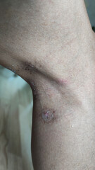 Paederus dermatitis, medically known as dermatitis linearis. You will feel burning pain, burn marks, and blisters or rashes. that looks like herpes or shingles. Footage After get the medicine