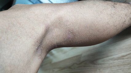 Paederus dermatitis, medically known as dermatitis linearis. You will feel burning pain, burn marks, and blisters or rashes. that looks like herpes or shingles. Footage After get the medicine