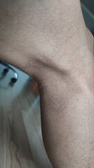 Paederus dermatitis, medically known as dermatitis linearis. You will feel burning pain, burn marks, and blisters or rashes. that looks like herpes or shingles. Footage After get the medicine