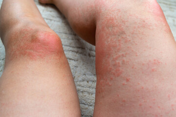 Allergic rash on the leg. Photodermatitis. Allergy to the sun, ultraviolet.