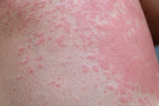 Allergic rash on the leg. Photodermatitis. Allergy to the sun, ultraviolet.