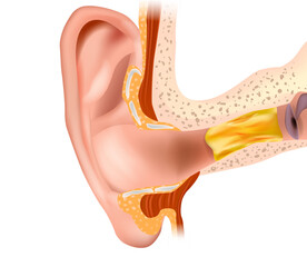 Anatomical illustration of a human ear with ear wax. Formation of earwax blockage.