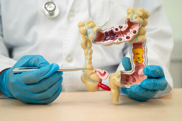 Ulcerative Colitis. Intestine, appendix and digestive system, doctor holding anatomy model for...