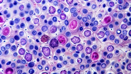 Microscopic view of abnormal lymph node tissue with distinctive follicular pattern, characteristic of follicular lymphoma, a type of non-Hodgkin lymphoma cancer.