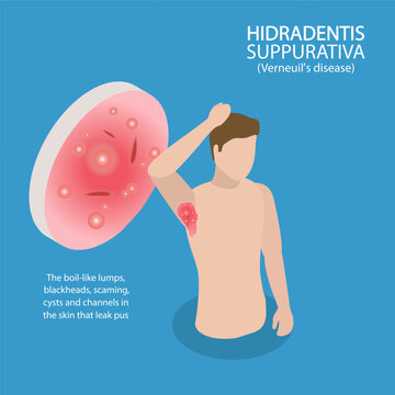 3D Isometric Flat Vector Illustration of Hidradenitis Suppurativa, Painful Lumps Under the Skin