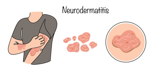 Neurodermatitis