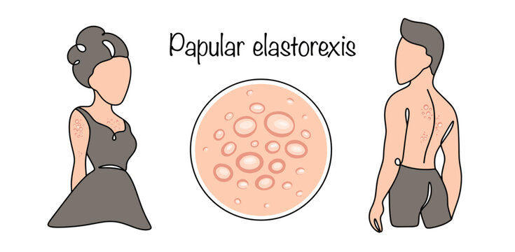Papular elastorexis