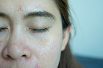 Close up of Asian woman face having freckles and enlarged pores problem on her skin.