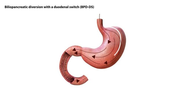 Biliopancreatic diversion with duodenal switch. BPD stomach surgery concept, weight loss gastric procedure. Abdomen laparoscopy. Overweight and obesity in human body flat medical Animation 3d