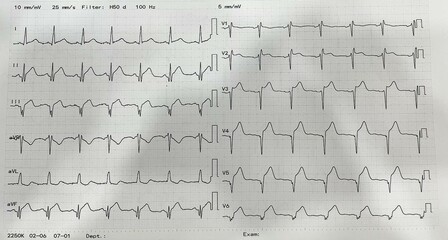 12 Lead ECG showing ST segment elevation in lead I aVL V3-V6 represents Acute anterior MI