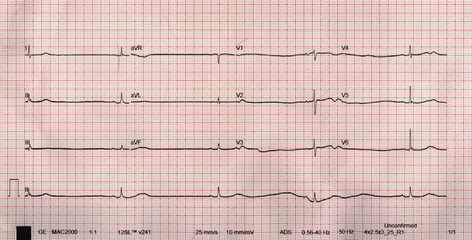 Sinus Bradycardia heart rate of < 60 bpm higher-degree AV block or CHB or SSS 