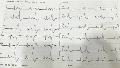 Premature Ventricular Complex (PVC) , SR with PVC ,Ventricular Arrhythmias