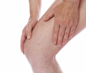 Woman suffering from varicose veins on white background, closeup