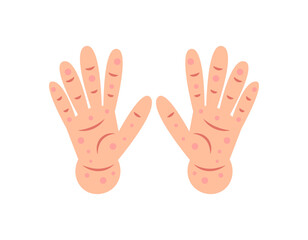 illustration of two palms covered with rashes and wounds. red spots on hands. symptoms of Singapore flu or chicken pox. hand and skin diseases. health problems. flat style design. graphic elements