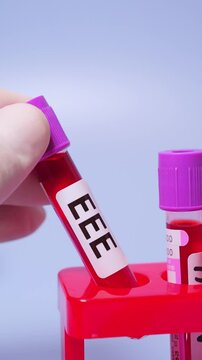 Eastern Equine Encephalitis (EEE) is an extremely rare but serious and often fatal infection that causes encephalitis or inflammation of the brain