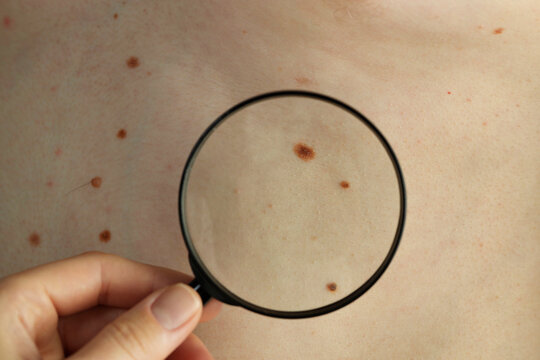 Dermatologist examining patient's birthmarks with magnifying glass, closeup