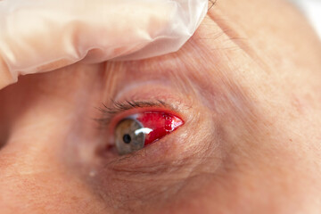 Detailed bloodshot male eye with ruptured blood vessel, emphasizing impact strain on vision, Eye health under scrutiny, Detecting vascular issues