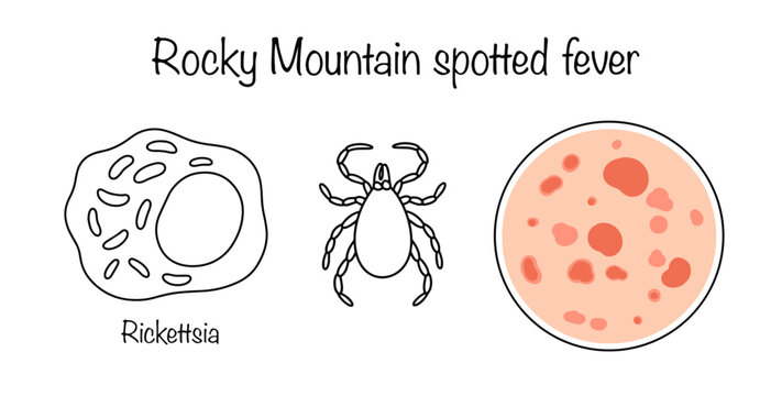 Rocky Mountain spotted fever