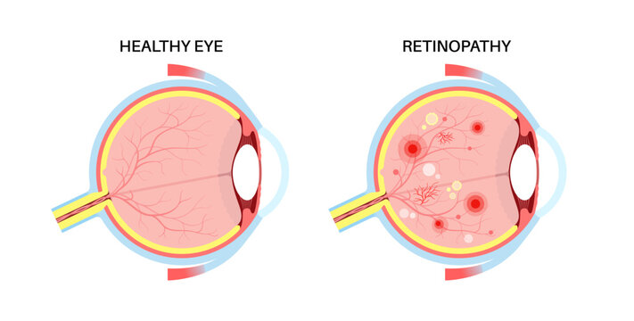 Diabetes related retinopathy