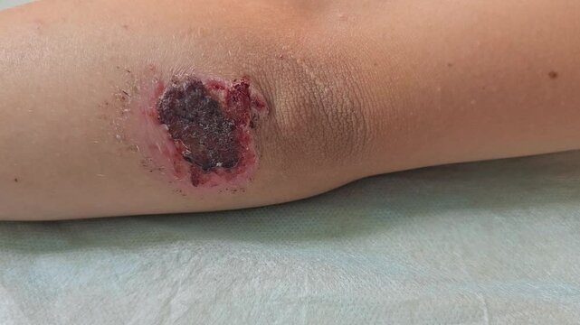 Deep scratches on the skin with bruises on the child face. Wounds, scratches, abrasions on child hand