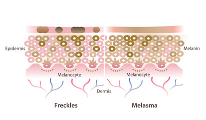 Cross section of freckles and melasma on skin layer vector illustration isolated on white background. Comparison of freckles are small flat brown spots and melasma is brown, blue gray patches on skin.
