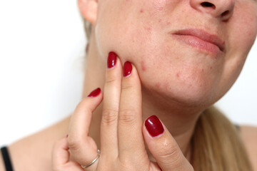 Close up of female face with red problematic acne skin and scars