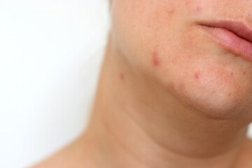 Obraz premium Close up of female face with red problematic acne skin and scars