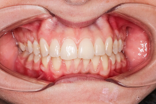 Frontal view close-up of dental maxillary and mandibular arches in occlusion with anterior biting teeth, cheeks and lips retracted with cheek retractor. Healthy gingival gum and no decay.	