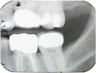 Dental X-rays of teeth in the back of the mouth, brightly showing crowns, root canals, and fillings where cavities and decay had been found.