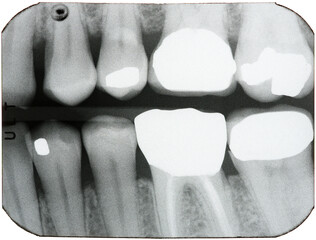 Dental X-rays of teeth in the back of the mouth, brightly showing crowns, root canals, and fillings where cavities and decay had been found.
