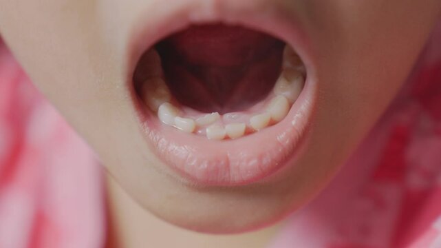Close-up child's mouth Show milk tooth and permanent tooth Overlapping. A beautiful little girl 6-7 years old has a loose tooth, replacement of permanent teeth, dentistry.