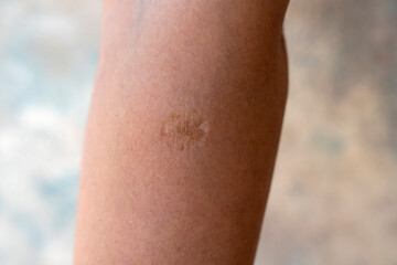  The woman has big scar from smallpox vaccine on her arm