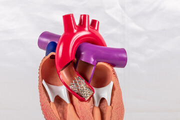 Cardiac model of Transcatheter aortic valve implantation (TAVI) for people education. Heart...