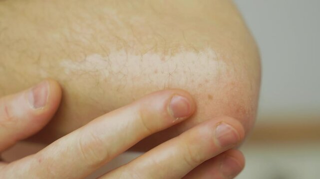 Vitiligo Close-Up: Male Elbow Examination | Skin Pigmentation Disorder in Detail | Dermatological Condition Awareness | Visual Guide to Autoimmune Skin Changes