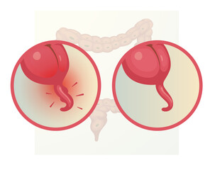  Appendicitis - Inflamed Appendix - Stock Illustration