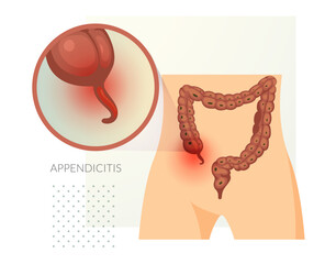  Appendicitis - Inflamed Appendix - Stock Illustration