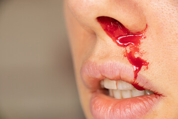 Face of a girl with a nosebleed at home, blood