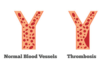 Normal Blood Vessels and Thrombosis. Health care and medicine concept vector