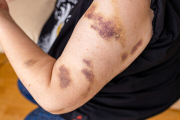 Close-up purple bruised on the arm of human from accident
