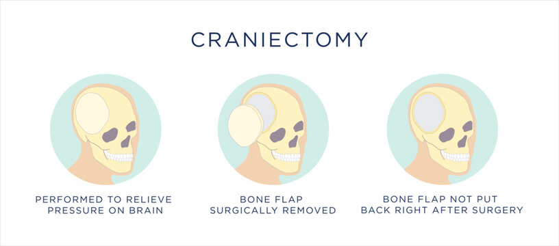 Craniectomy procedure illustration stock illustration