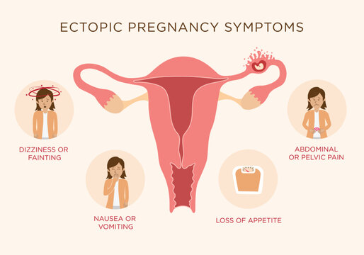 Ectopic pregnancy symptoms stock illustration